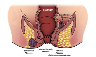 Fistula
