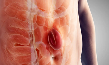 Hernia