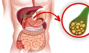Gall Bladder Stone